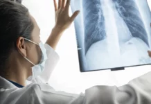 Se llegó a un consenso nacional sobre las recomendaciones para la detección temprana del cáncer de pulmón